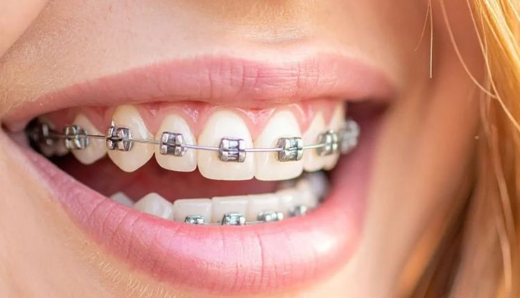 Orthodontic