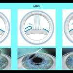 Understanding the Different Types of Vision Correction Surgery