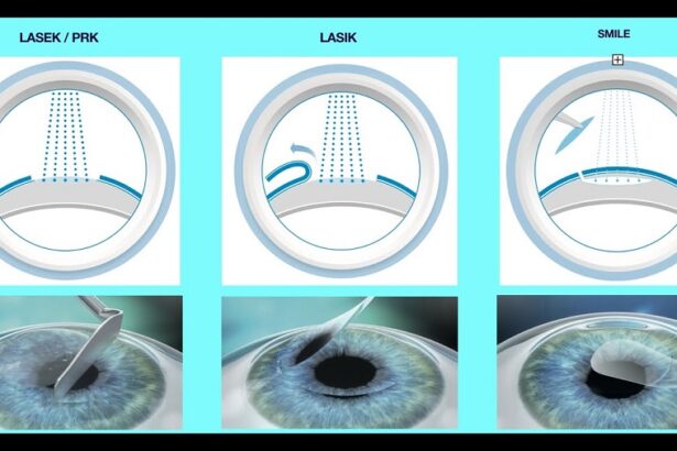 Understanding the Different Types of Vision Correction Surgery