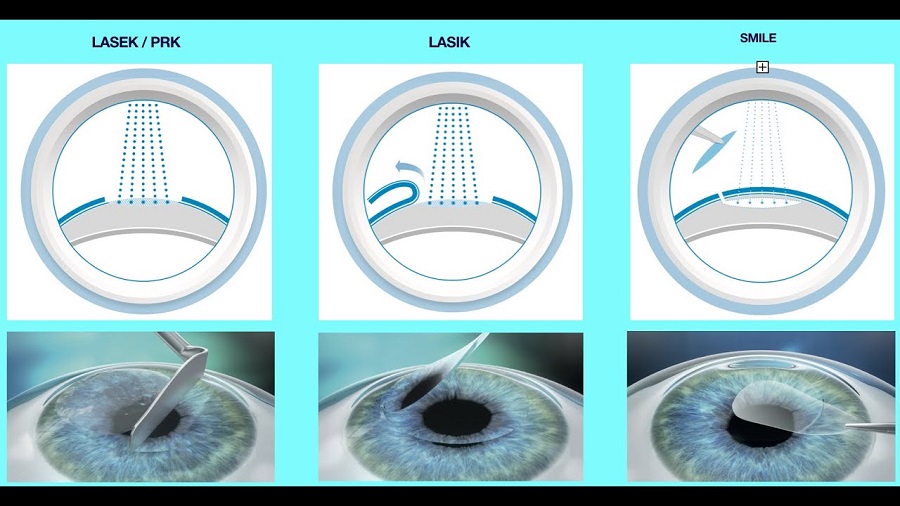 Understanding the Different Types of Vision Correction Surgery