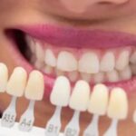 Porcelain Veneers