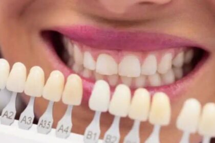 Porcelain Veneers