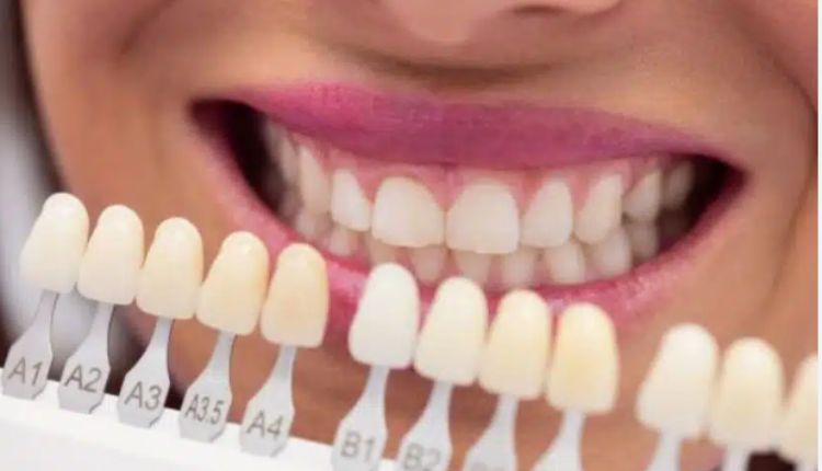 Porcelain Veneers