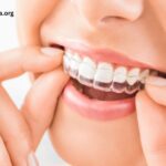 Thinking about Clear Aligners Here’s a simple guide for you!
