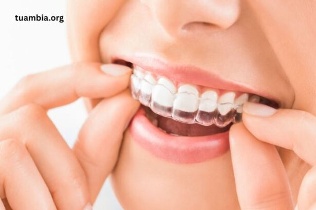 Thinking about Clear Aligners Here’s a simple guide for you!