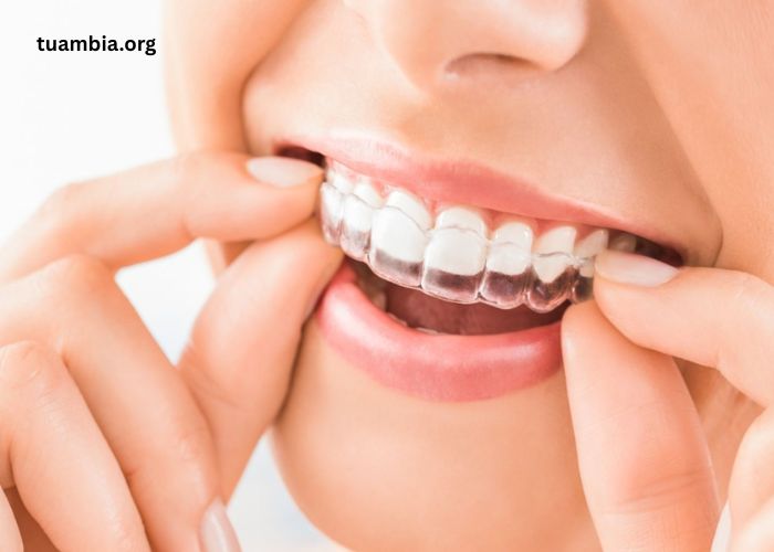 Thinking about Clear Aligners Here’s a simple guide for you!