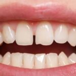 Tooth