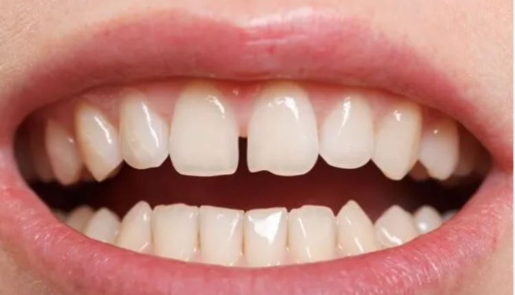 Tooth