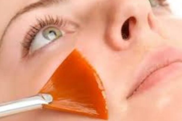 Chemical Peel